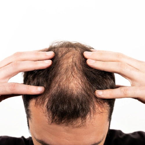 female hair loss treatment
